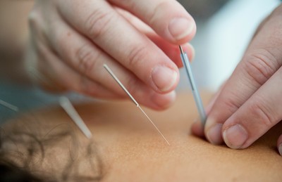Dry Needling Braintree Chiropractor